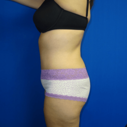 Manhattan abdominoplasty after 5